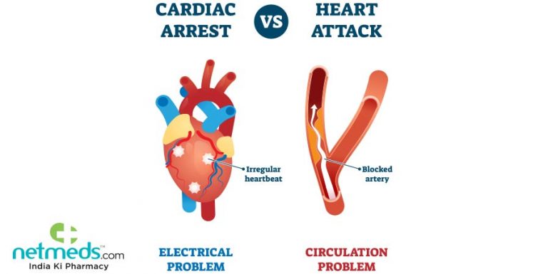 Signs of Before Cardiac Arrest Symptoms and Treatment
